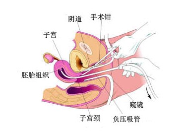 无痛人流费用最新,无痛人流费用最新动态,了解、理解与关爱,让每一分投入都值得,无痛人流费用最新动态,了解、关爱与投入的价值