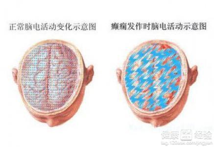 痫病的最新治疗方法,痫病最新治疗方法,曙光初现的希望之光,痫病最新治疗方法揭秘,曙光初现的希望之光