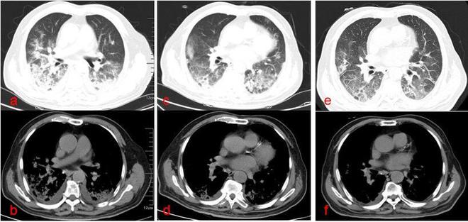 新型冠菌病毒最新,新型冠菌病毒的最新进展,希望之光在前方,新型冠菌病毒最新进展,希望之光初现,研究取得积极成果